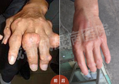 成都风湿医院痛风患者治疗前后双手情况对比.jpg