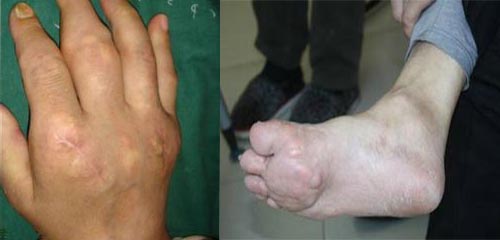 成都风湿医院痛风症状.jpg