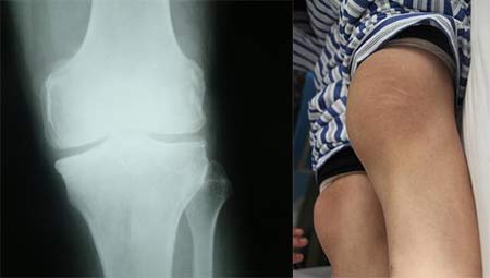 成都风湿医院患者膝关节症状和X线片.jpg