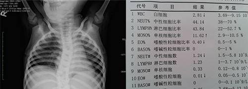 成都风湿医院强直患者X线检查脊柱侧弯及检查化验单.jpg