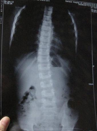 成都风湿医院强直患者CT检查脊柱侧弯.jpg