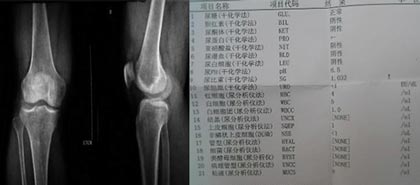 成都风湿医院患者治疗前膝关节CT检查和化验单.jpg