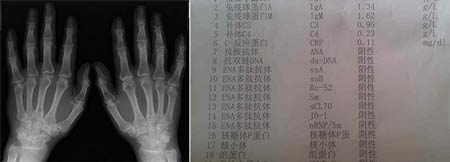 成都风湿医院治疗后患者手指关节CT检查及化验单.jpg