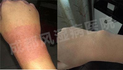 成都风湿医院患者手腕治疗前后对比.jpg