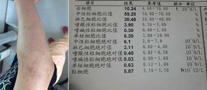 成都风湿医院患者治疗前关节症状和检查化验单.jpg