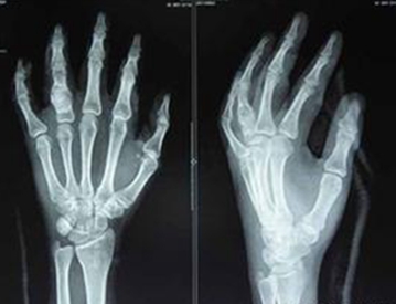 成都风湿医院患者手部CT.jpg