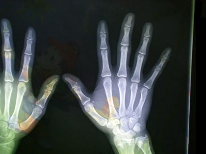 成都风湿医院患者治疗前腕关节CT检查.jpg