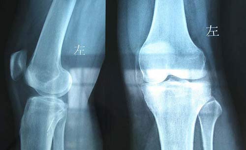 成都风湿医院患者CT检查膝关节症状.jpg