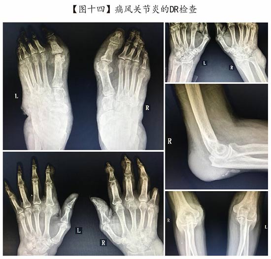 图十四-痛风关节炎的DR检查.jpg