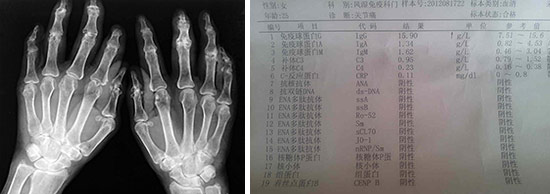 成都风湿医院类风湿患者治疗前弯曲症状.jpg