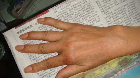 成都风湿医院治疗后患者右手情况.jpg