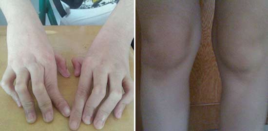 成都风湿医院患者双手关节、膝关节症状表现.jpg