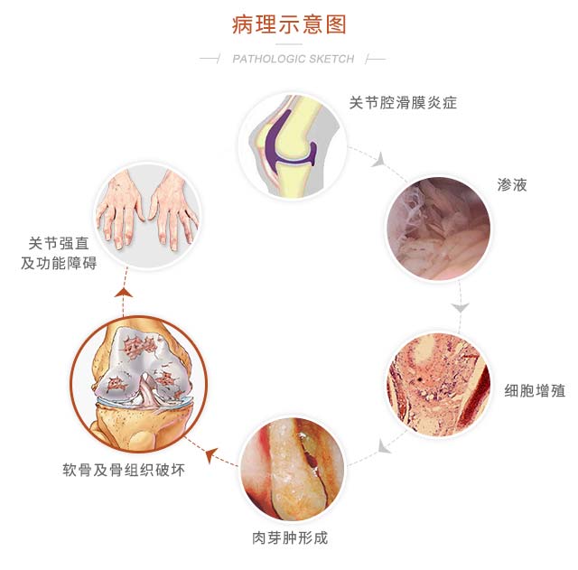 自体软骨细胞培植(MACI) 自体软骨细胞培植(MACI)