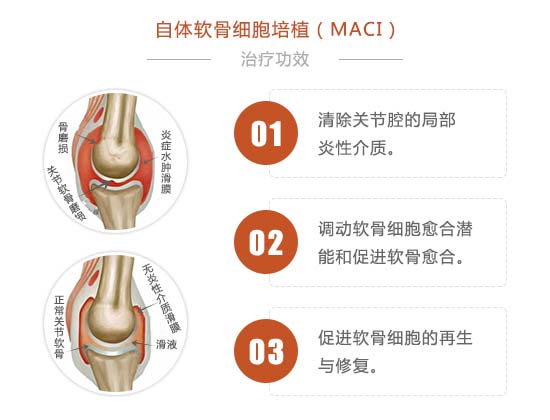 自体软骨细胞培植(MACI)