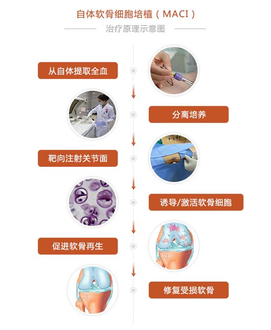 自体软骨细胞培植(MACI)