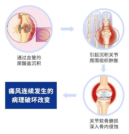 欧美新一代MSUS肌骨超声技术 痛风超声四种征象让“痛”看得见